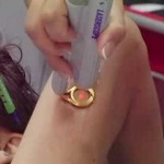 Laser Therapy for Stretch Marks